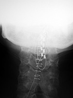Dorsal column stimulator in upper cervical spine